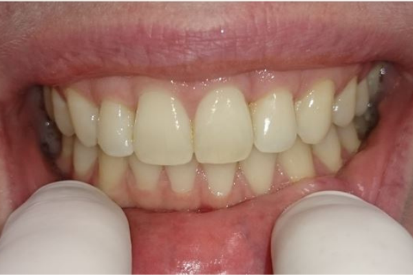 Leczenie ortodontyczne przeprowadzone aparatem stałym. (pracę wykonała: lek. dent. Anna Piętak). Zdjęcie po.