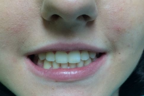 Leczenie ortodontyczne przeprowadzone aparatem stałym. (pracę wykonała: lek. dent. Anna Piętak). Zdjęcie po.
